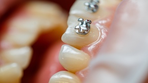 À Rouen, l'impudence d'une orthodontiste mise en cause pour une fraude majeure à la sécurité sociale